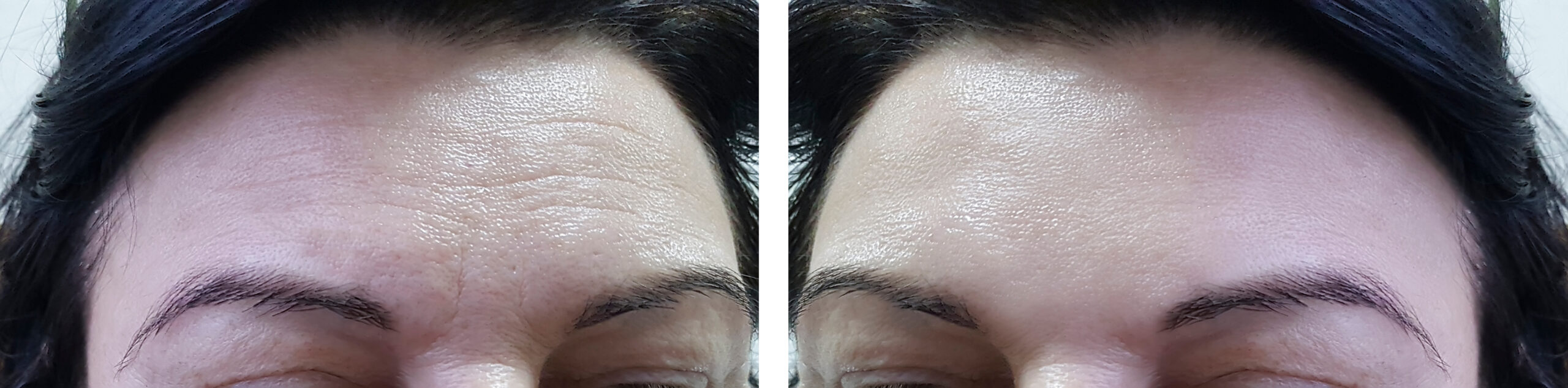 Face,Woman,Forehead,Wrinkles,Before,And,After,Cosmetic,Procedures