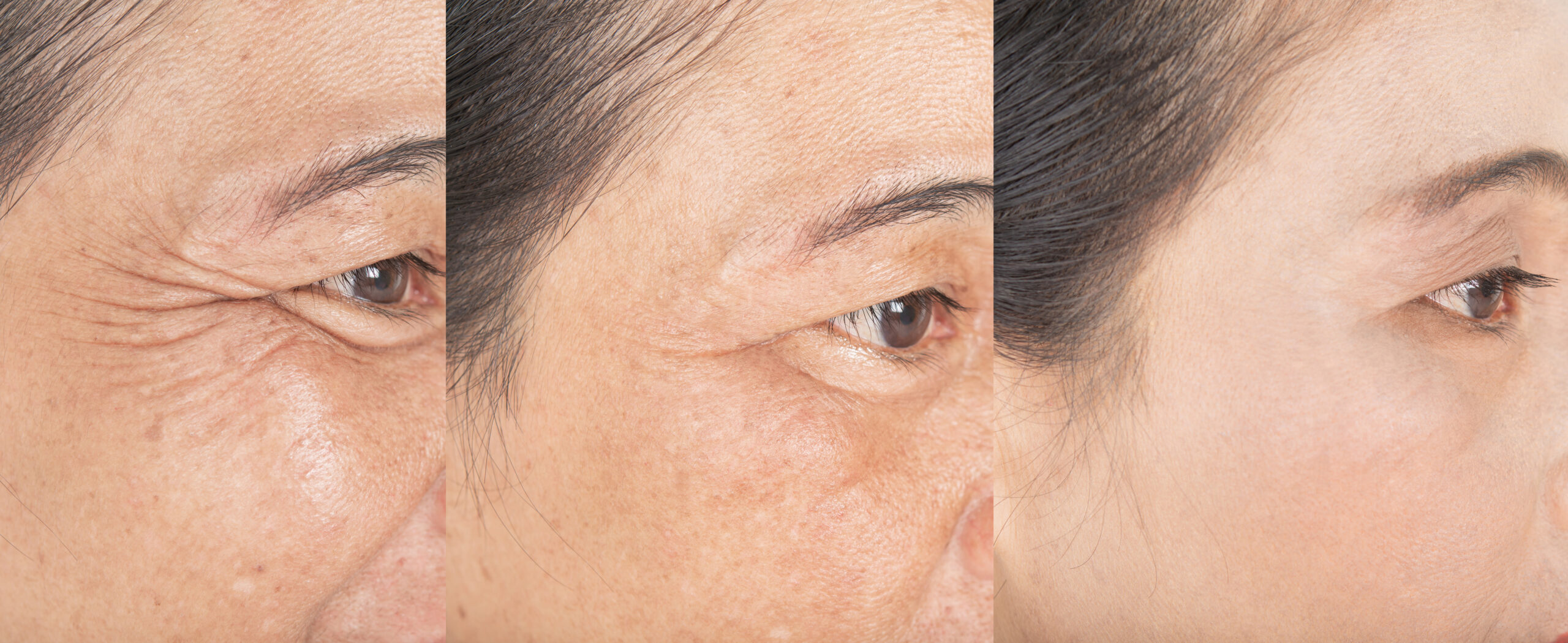 Wrinkles,On,The,Eyes.,And,Before,And,After,Melasma,And